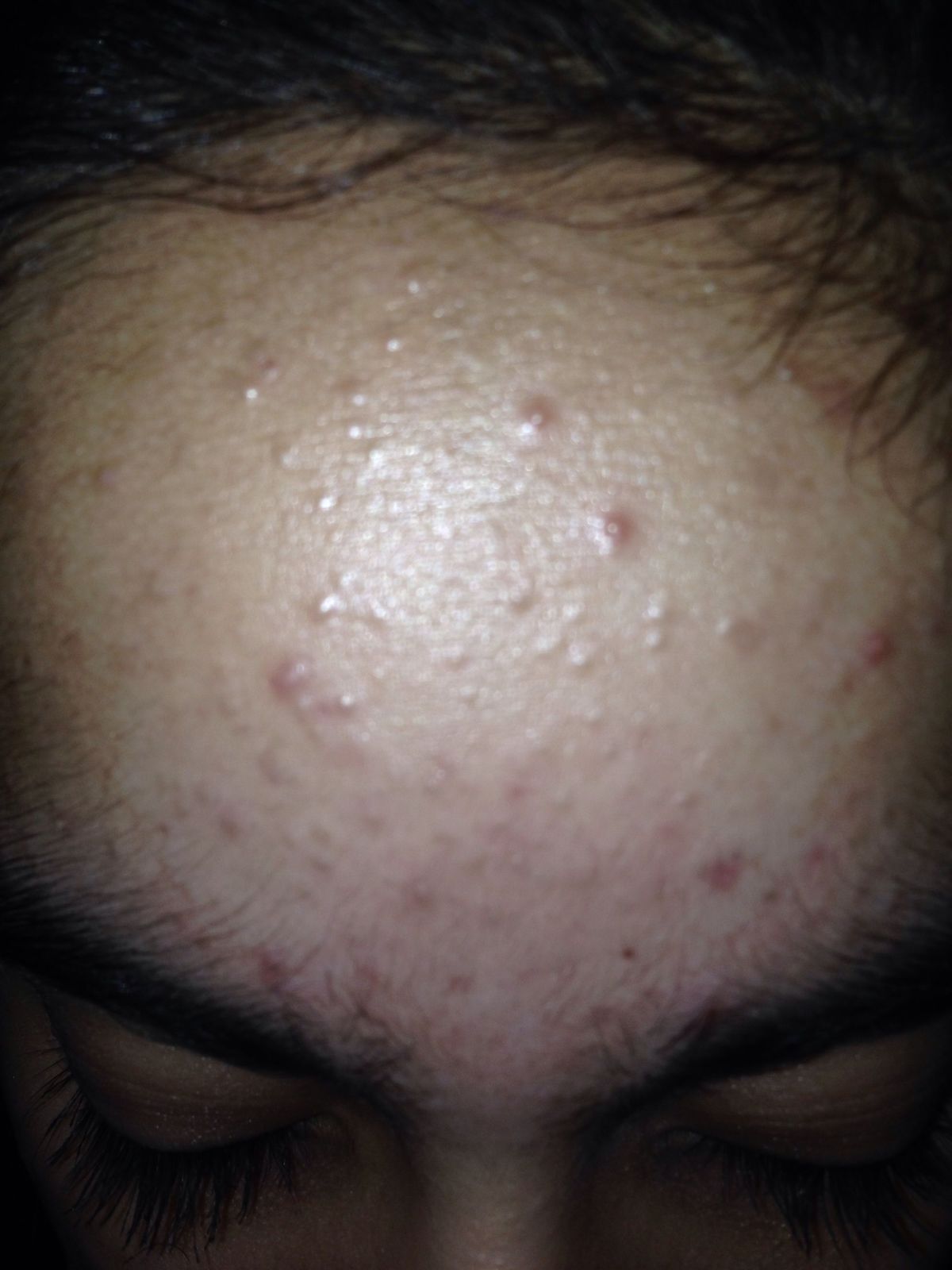 Small Skin Colored Bumps On Forehead Naturalskins